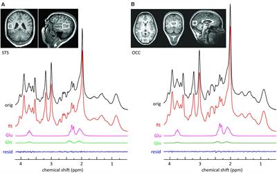 Glutamate Concentration in the Superior Temporal Sulcus Relates to Neuroticism in Schizophrenia